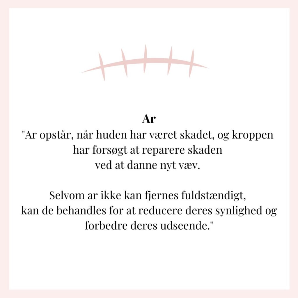 ar efter strækmærker og behandling med creme